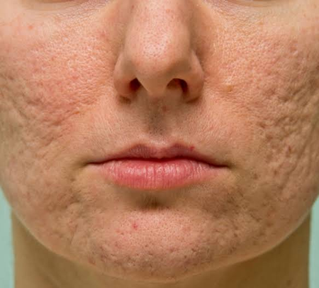 Vamos falar sobre cicatrizes de acne?
Introdução 1: As cicatrizes de acne te incomodam?
Introdução 2: Quer suavizar as cicatrizes de acne?
A acne por si só já é algo que incomoda muita gente, geralmente ela aparece em nossa adolescência causando lesões em nossa pele.
Às vezes se estende em nossa vida adulta. Além de mexer com nossa auto estima ela também pode deixar marcas se não tiver o devido cuidado.
Hoje em dia os tratamentos estão cada vez mais eficazes trazendo resultados satisfatórios em muitos clientes e nós do Centro de Estética Tatiane Braga temos procedimentos fantásticos para te ajudar a reduzir a cicatriz de acne.
Nosso queridinho é o:
Microagulhamento
Tenho certeza que você já ouvir falar desse procedimento, mas já experimentou?
Nossa técnica é aplicada individualmente e, tudo será observado na sua avaliação.
O que precisamos fazer com sua pele é estimular o colágeno, regeneração do tecido e fornecer estrutura e sustentação na derme.
Vamos fazer uma avaliação e montar um protocolo exclusivo para sua pele?
Deixe seu telefone abaixo e entraremos em contato para agendar sua avaliação com nossas profissionais.