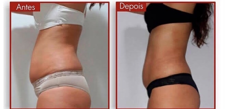 💥 ATENÇÃO💥
SAVE THE DATE 18.09 ❄️❄️ Criolipólise de placas ❄️❄️
Procedimento indolor que ajuda a eliminar gordura localizada, conhecida como #liposemcorte
A técnica consiste em congelar a gordura por meio das placas aplicadas na superfície do local com gordurinha indesejada!
O procedimento dura em torno de 40 minutos e é totalmente indolor, sem sucção e não deixa hematomas. Reduz de 25% a 35% da gordura.
🍇🍉🤷🏼♀️🙅🏻♀️O resultado depende do comprometimento da cliente com hábitos mais saudáveis.
As 3 primeiras clientes que fecharem o pacote irá ganhar uma cortesia sensacional!!