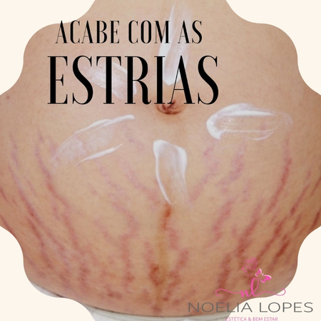 Tratamento para Estrias
Estrias são cicatrizes decorrentes do rompimento das fibras elásticas e colágenas constantes na pele. O aparecimento de estrias ocorre durante períodos como gravidez, ganho de peso e fase de crescimento e também durante a adolescência.
O tratamento de estrias é um procedimento bastante procurado para a melhora na aparência da pele, tanto as mulheres quanto os homens. O tratamento para estrias não se resume a um único procedimento, mas especialmente a uma combinação de técnicas que pode ajudar na atenuação das marcas de estrias brancas e remoção das estrias vermelhas ou rosadas.
Qual o melhor tratamento de estrias?
A melhor resposta para esta pergunta se dá no ato da consulta, pois a depender da extensão e do tempo de existência das marcas há uma combinação específica de tratamentos que pode ser mais eficaz. Conheça os tratamentos de estrias mais comuns e eficientes:
Microdermoabrasão
A microdermoabrasão, também conhecida como peeling de cristal, consiste, basicamente, na esfoliação da pele com cristais de óxido de alumínio que atuam eliminando a camada mais superficial da pele. Após esse efeito, as células da região se regeneram de maneira mais saudável, sem correr o risco de rompimento das fibras elásticas e colágenas.
Vacuoterapia ( conhecida como método stiort)
Consiste em um aparelho a vácuo, combinado com dermocosmético, que quando passadas na pele, traz o sangue para a superfície, estimulando a passagem da corrente sanguínea novamente para a região, tornando as estrias tratáveis.
Microagulhamento
O microagulhamento é realizado por meio de microperfurações na pele com agulhas metálicas muito finas. O tratamento induz a produção de colágeno e de outras fibras naturais presentes na pele, além de promover o espessamento da epiderme. Como resultado, as estrias desaparecem e a pele da região fica com uma aparência mais satisfatória sob o ponto de vista estético.
Assim como tem vários outros tratamentos.
Agende sua consulta para maiores detalhes