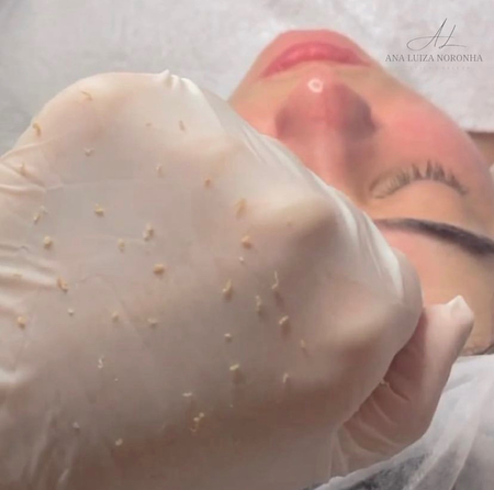 A limpeza de pele é importante para remover cravos, espinhas e demais impurezas causadas por fatores como: poluição, radiação solar, estresse, alteração hormonal, maquiagem, entre outros.
Ela proporciona uma aparência limpa e saudável, além de prevenir o envelhecimento precoce e deixa a pele preparada para receber os cosméticos de uso diário.
Pessoas que não fazem limpeza de pele tem aumento na oleosidade, fechamento dos poros e aparecimento de cravos e espinhas. Junto a fatores como a poluição e radiação solar, isso pode levar ao envelhecimento precoce da pele.
Por isso, a limpeza de pele é tão importante. Além disso, com a renovação celular proporcionada pela esfoliação é possível também combater as temidas rugas e pés de galinhas.